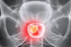 X-ray scan of pelvis with highlighted prostate gland in red for medical diagnosis